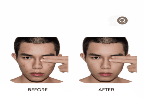 “Organic Anti-Acne Three-Step Skincare System – Moderate to Severe Acne-Prone Skin”